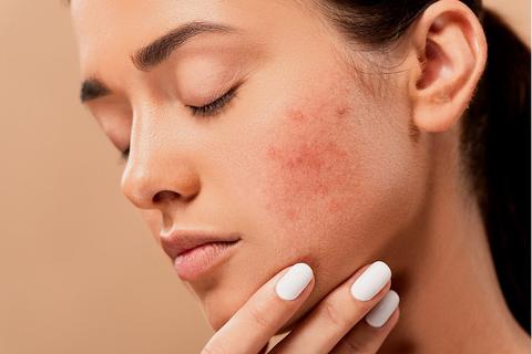Acne and stress
